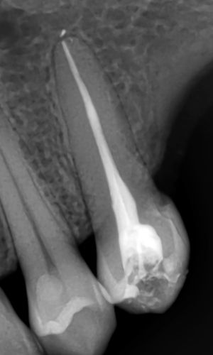 Root Canal Treatment x-ray