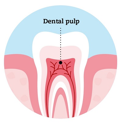 Root Canal Treatment pulp, teeth