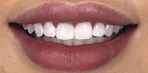 In Chair Teeth Whitening Before After 1