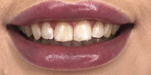 In Chair Teeth Whitening Before 1