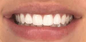 In Chair Teeth Whitening After 1