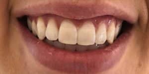 In Chair Teeth Whitening Before 1