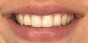 In Chair Teeth Whitening Before 1