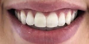 In Chair Teeth Whitening After 1