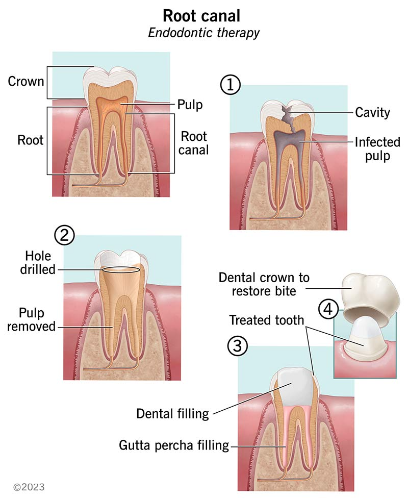 Root Canal What It Treats Procedure Recovery