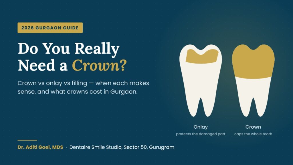 Dental onlay vs dental crown illustration – Dentaire Smile Studio, Gurgaon