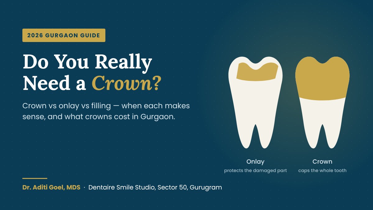 Dental onlay vs dental crown illustration – Dentaire Smile Studio, Gurgaon